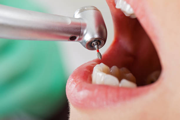 Best Emergency Tooth Extraction in Wailua, HI